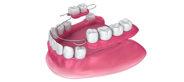 dental prosthesis istanbul