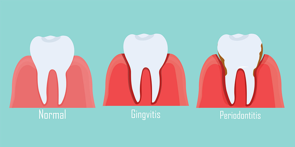 periodontitis nedir