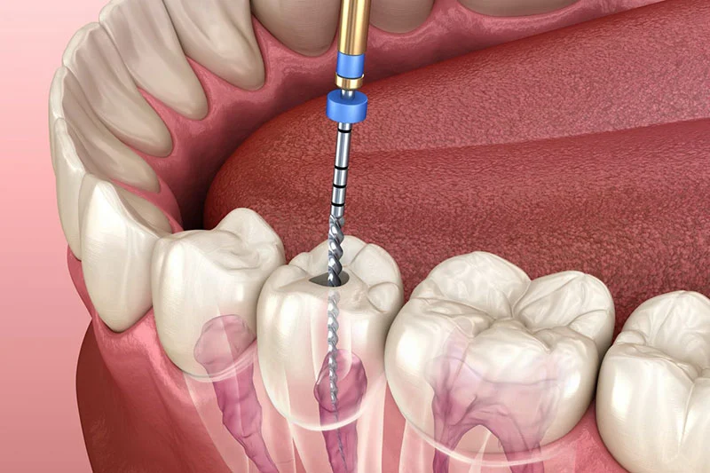 root canal treatment istanbul