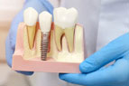dental implants turkey istanbul