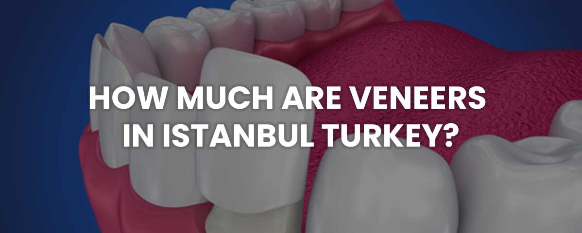 how much are veneers in istanbul turkey