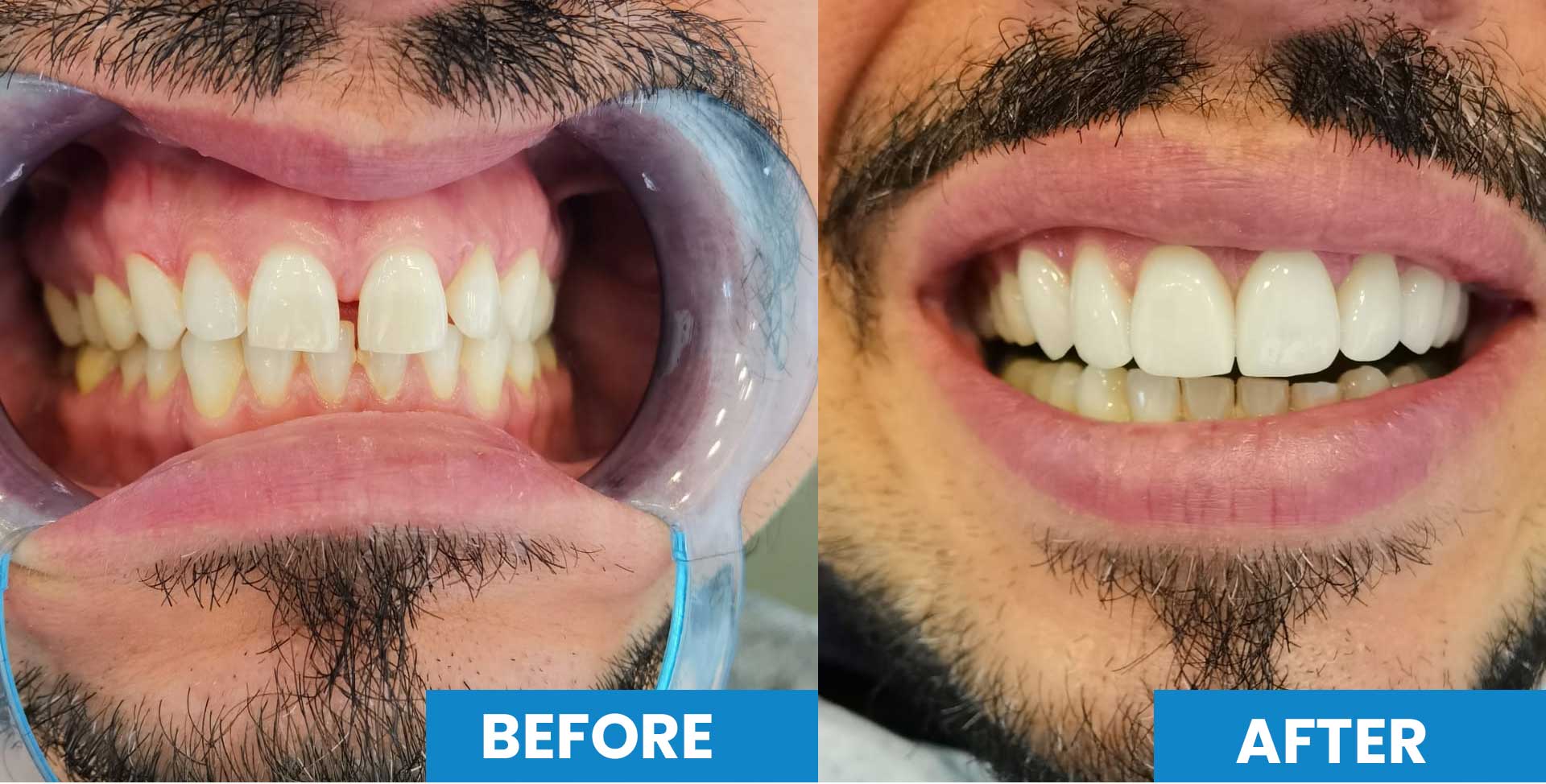 How much are veneers in Istanbul Turkey? Before After