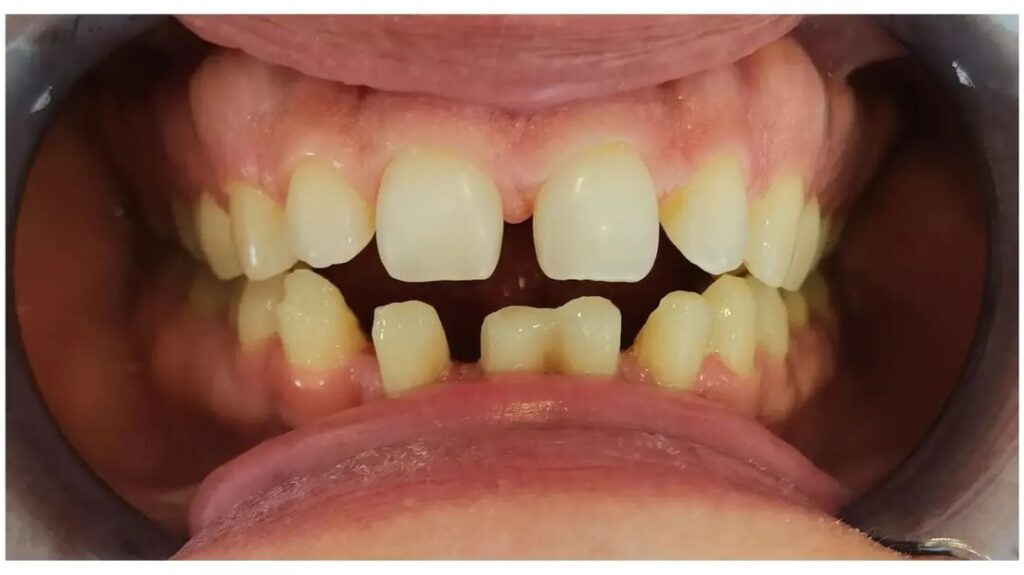 Zirconia vs Porcelain A Comprehensive Comparison
