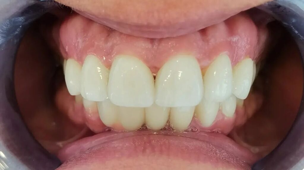 Zirconia vs Porcelain A Comprehensive Comparison