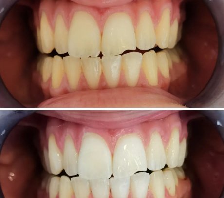 teeth whitening before after